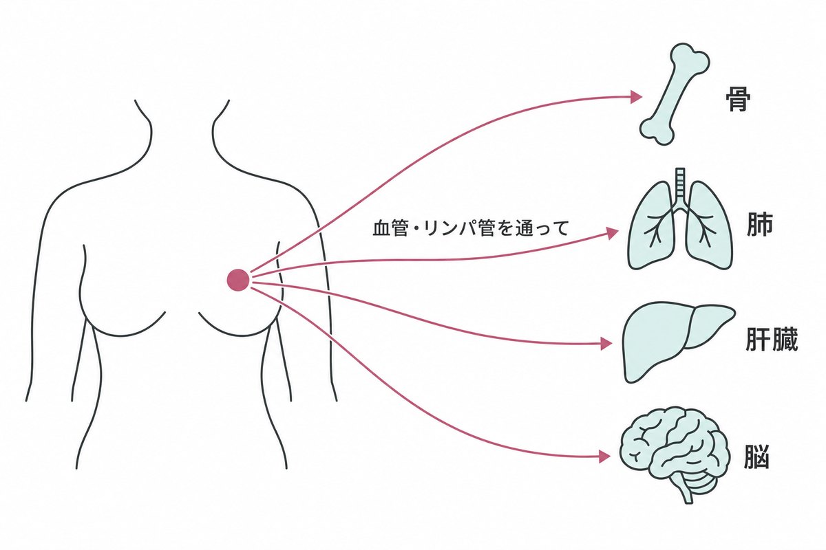 転移の模式図。乳房のがんから血管・リンパ管を通って、骨・肺・肝臓・脳へ矢印が伸びている