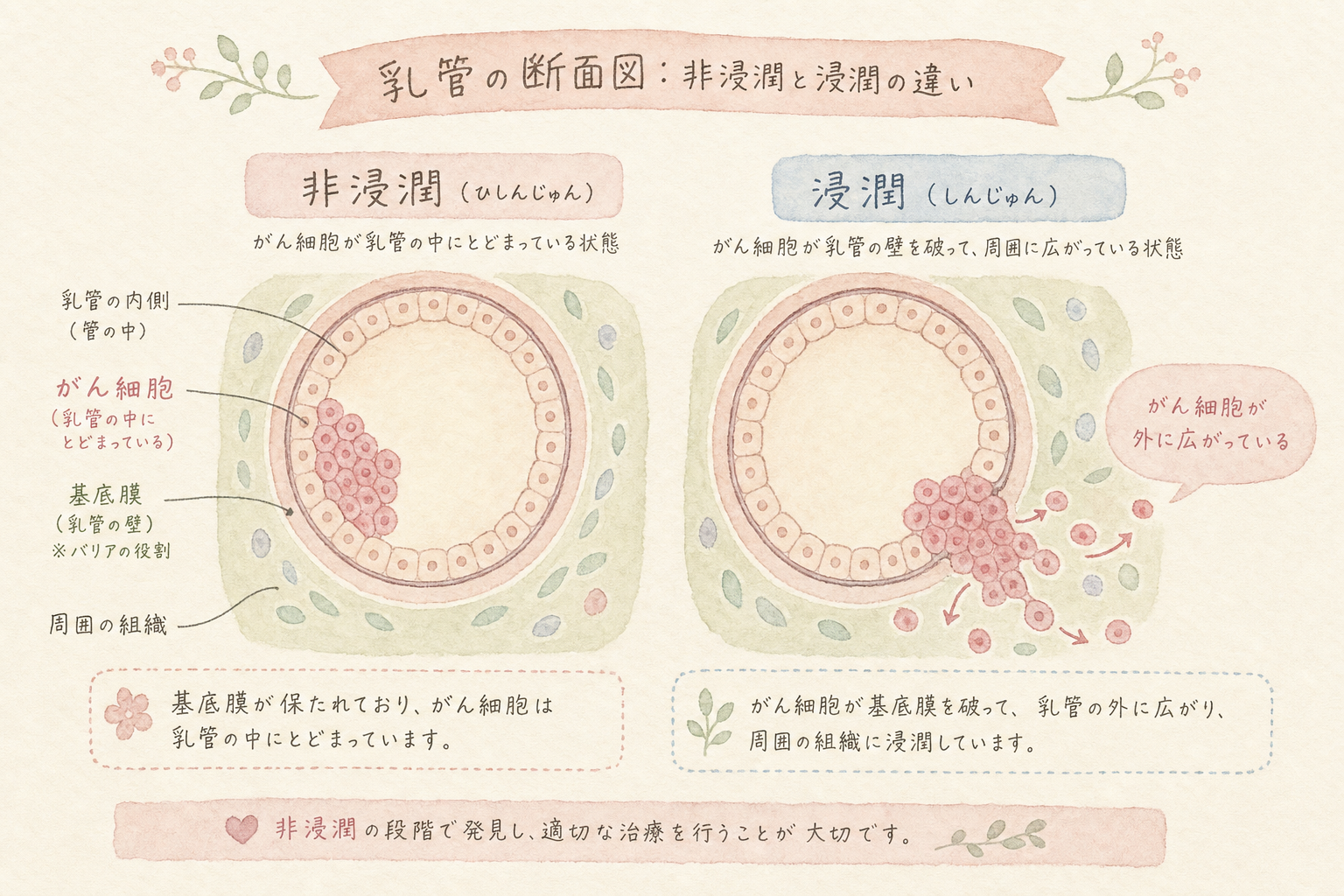 乳管の断面図。左側は管の中だけにがん細胞がある（非浸潤）、右側は管の壁を破って外に広がっている（浸潤）の対比図