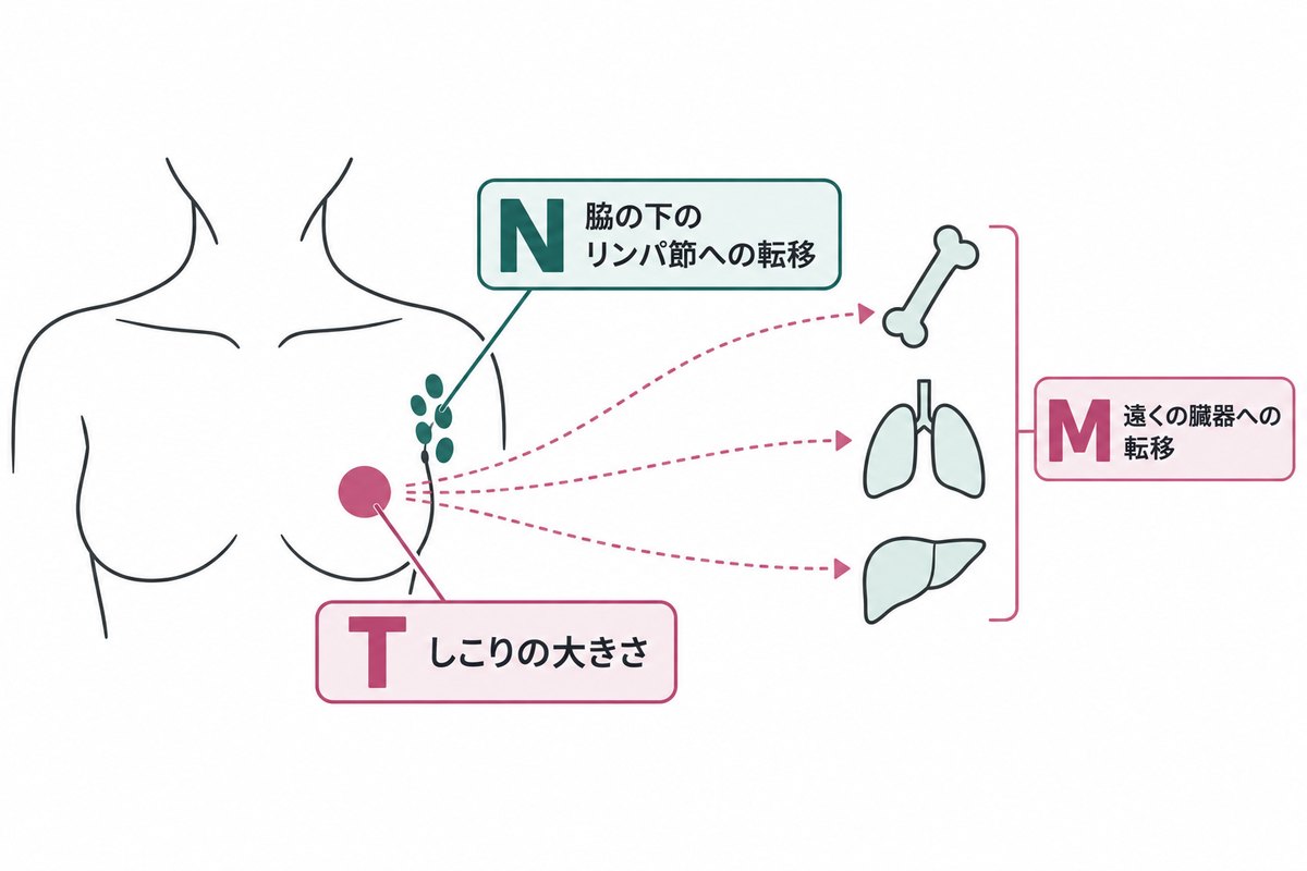 TNMの模式図。乳房のしこりの大きさ（T）、脇の下のリンパ節への転移（N）、骨・肺・肝臓など遠くの臓器への転移（M）