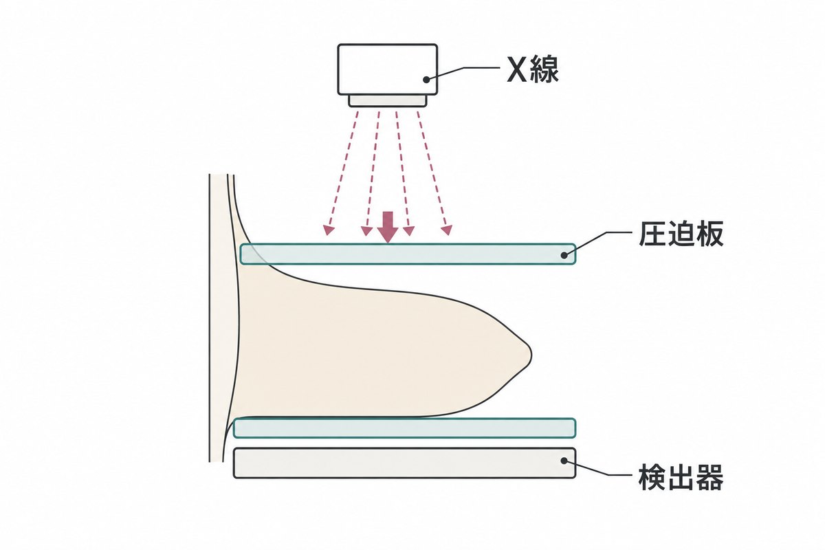 マンモグラフィの模式図。乳房を2枚の圧迫板で挟んで薄くし、上からX線を当てて下の検出器で写す