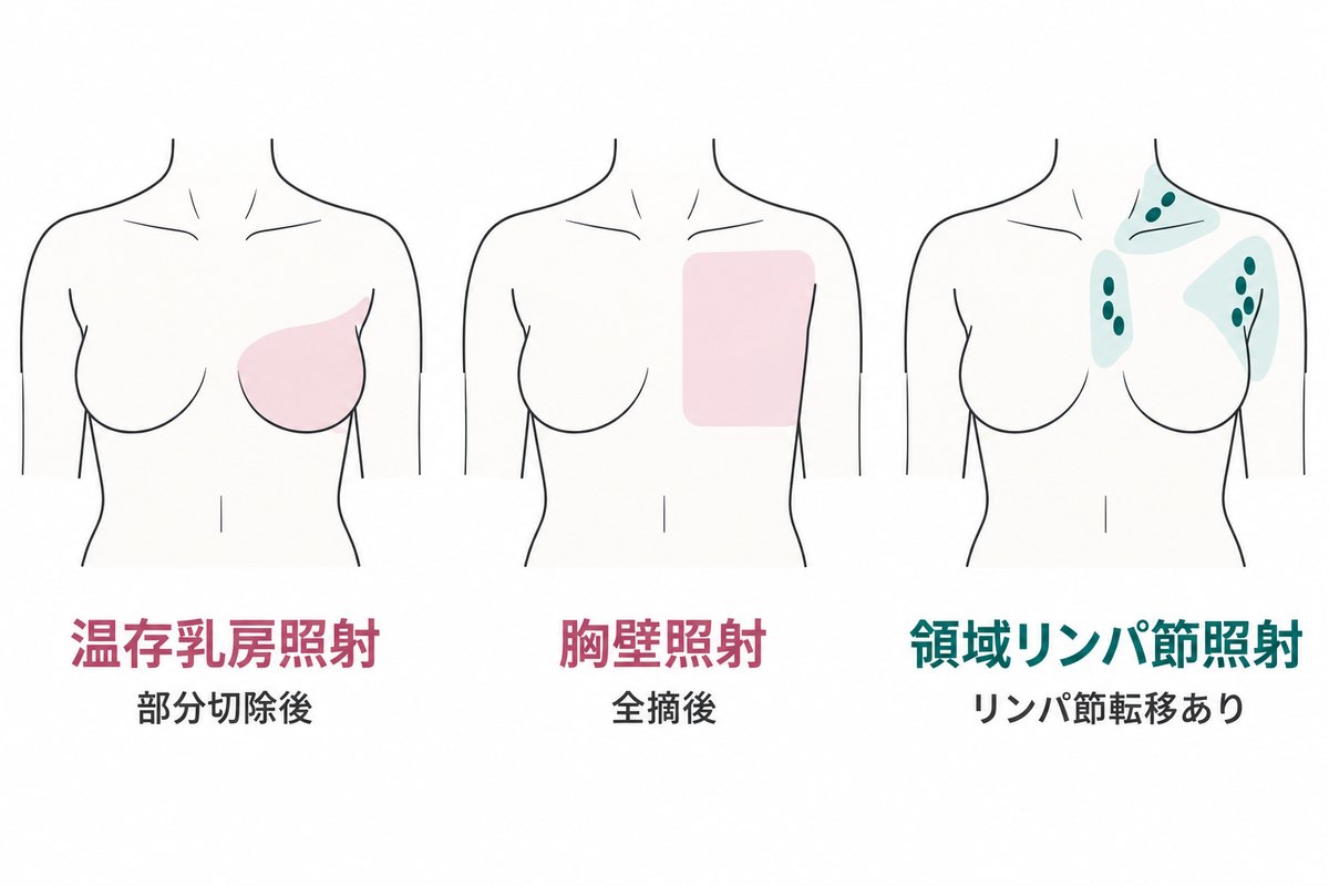 放射線を当てる場所の模式図。温存乳房照射（部分切除後）は残った乳房全体、胸壁照射（全摘後）は平らになった胸の壁、領域リンパ節照射（リンパ節転移あり）はわきの下・鎖骨の上下・胸骨の裏