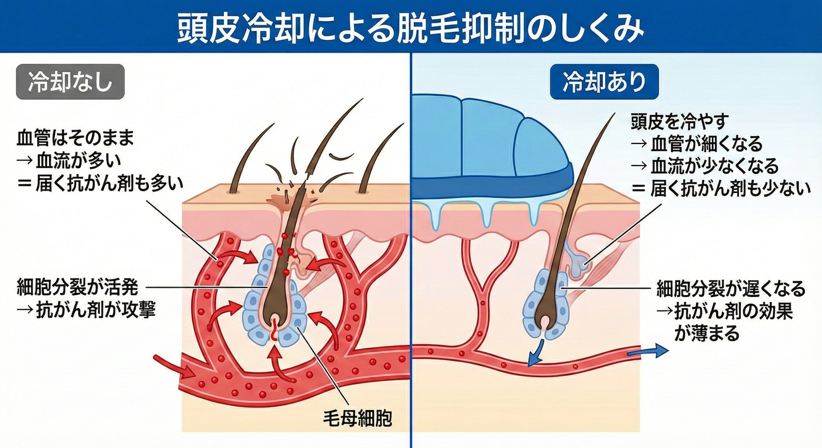 頭皮冷却で抗がん剤の脱毛を予防できるって本当？どんなしくみ？