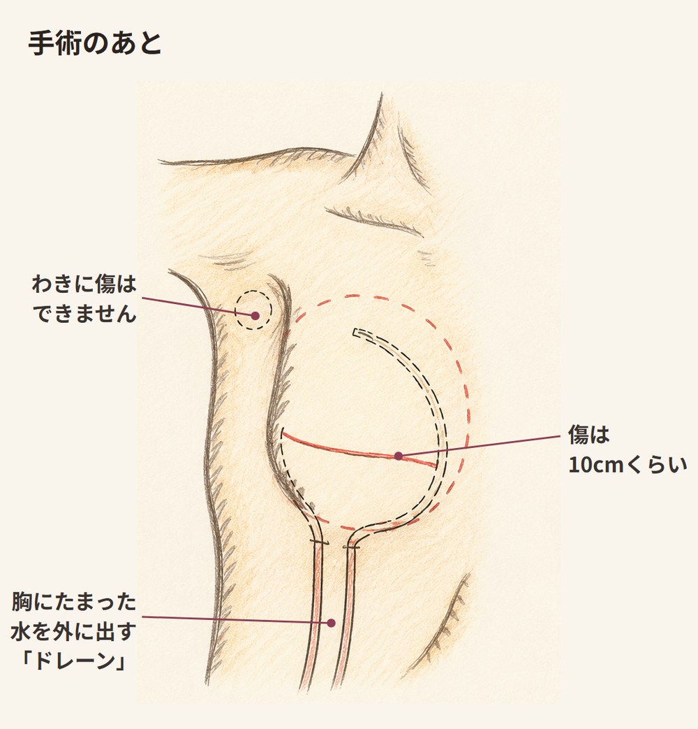 手術のあと。まっすぐな傷と、その下から出ている2本のドレーンが描かれた図