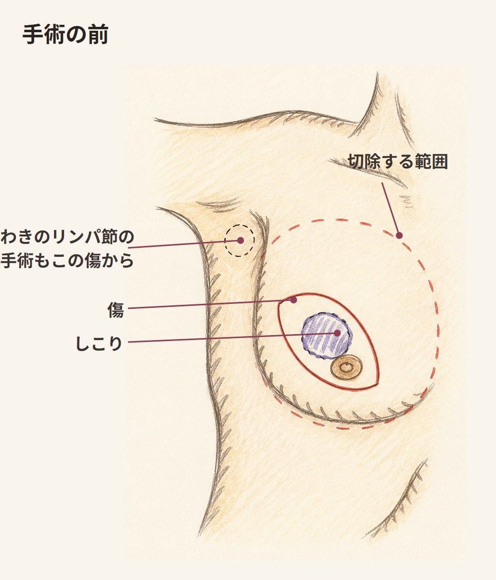手術の前。乳頭と乳輪を含む紡錘形の切開線と、その外側に切除する範囲、中にしこりが描かれた図